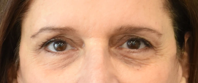 Brow Lift Patient 10 Set 1 After