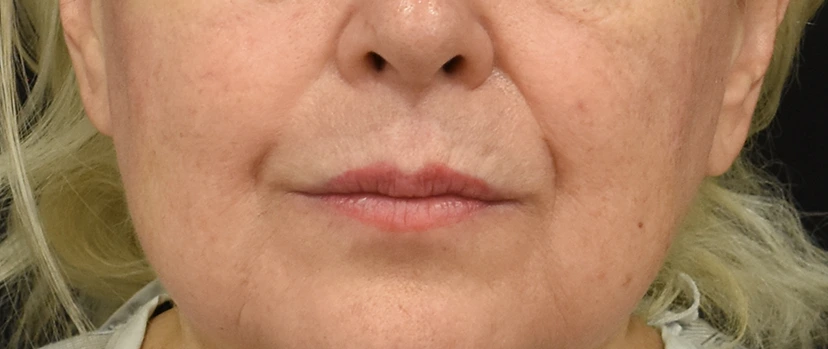 Lip Lift Patient 6 Set 1 Before