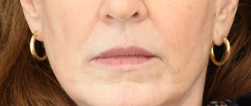Lip Lift Patient 10 Set 1 Before